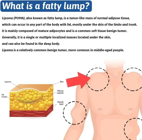 Lipoma Removal Cream